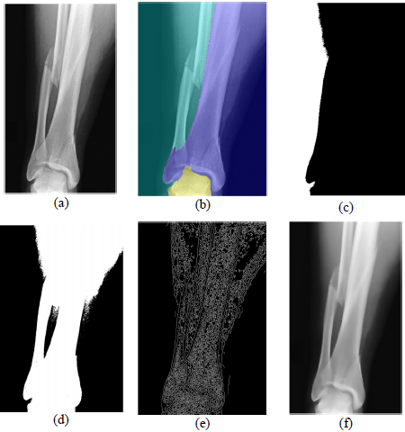 Imagem original de raio-x b) Extração da região de interesse com o Watershed c) Segmentação da imagem com crescimento de região d) Extração da região de interesse com o método thresholding e) Deteção de bordas com o método Canny f) Suavização da imagem com filtro Gaussiano [16]