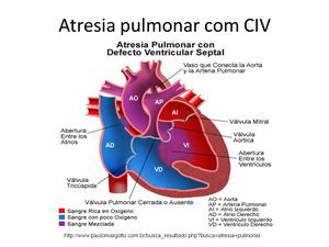 Atresia pulmonar.jpg